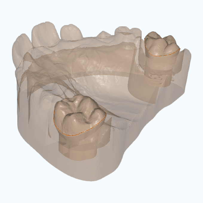 3D model with molars ditched for a rapid palatal expander