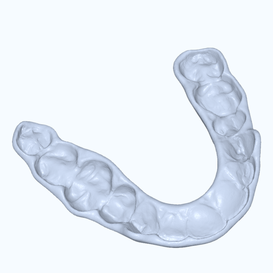 3D model of an occlusal splint on a lower arch